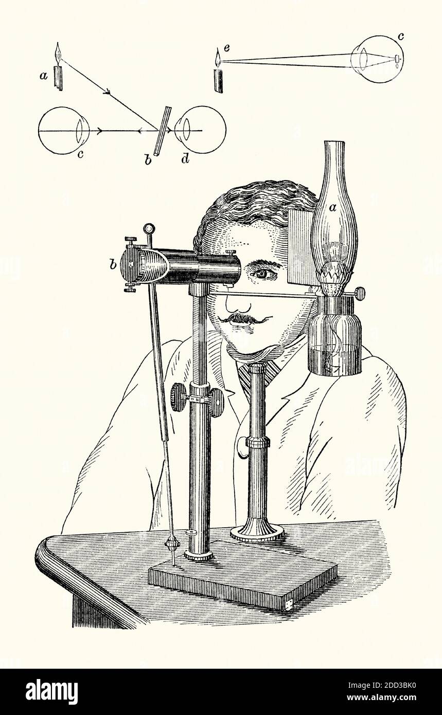 An old engraving of an ophthalmoscope. It is from a Victorian book of the 1880s. Ophthalmoscopy (or funduscopy) allows a doctor to see inside the eye using this device. This version is Knapp’s auto-ophthalmoscope, set up in front of a patient. A light source (a) supplies light to an inclined reflector (b) which bounces the light towards the patient’s pupil (c in the top diagram). A hole in the plate at the rear of the instrument allows the doctor to view (d). The ophthalmoscope was invented by Hermann von Helmholtz in 1851. Hermann Knapp of New York was an expert instrument and lens maker. Stock Photo
