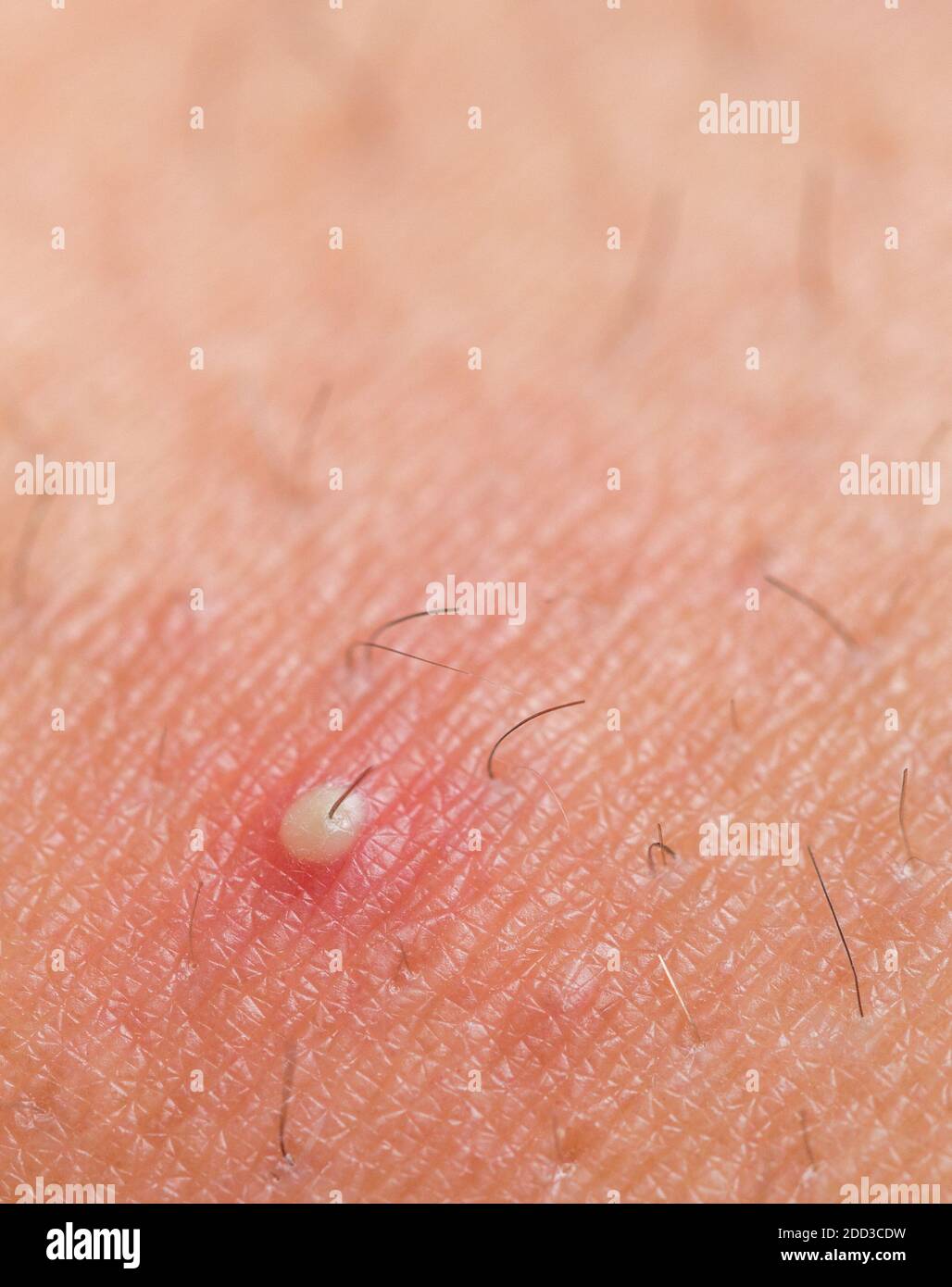 Infected ingrown hair with pus closeup view Stock Photo - Alamy