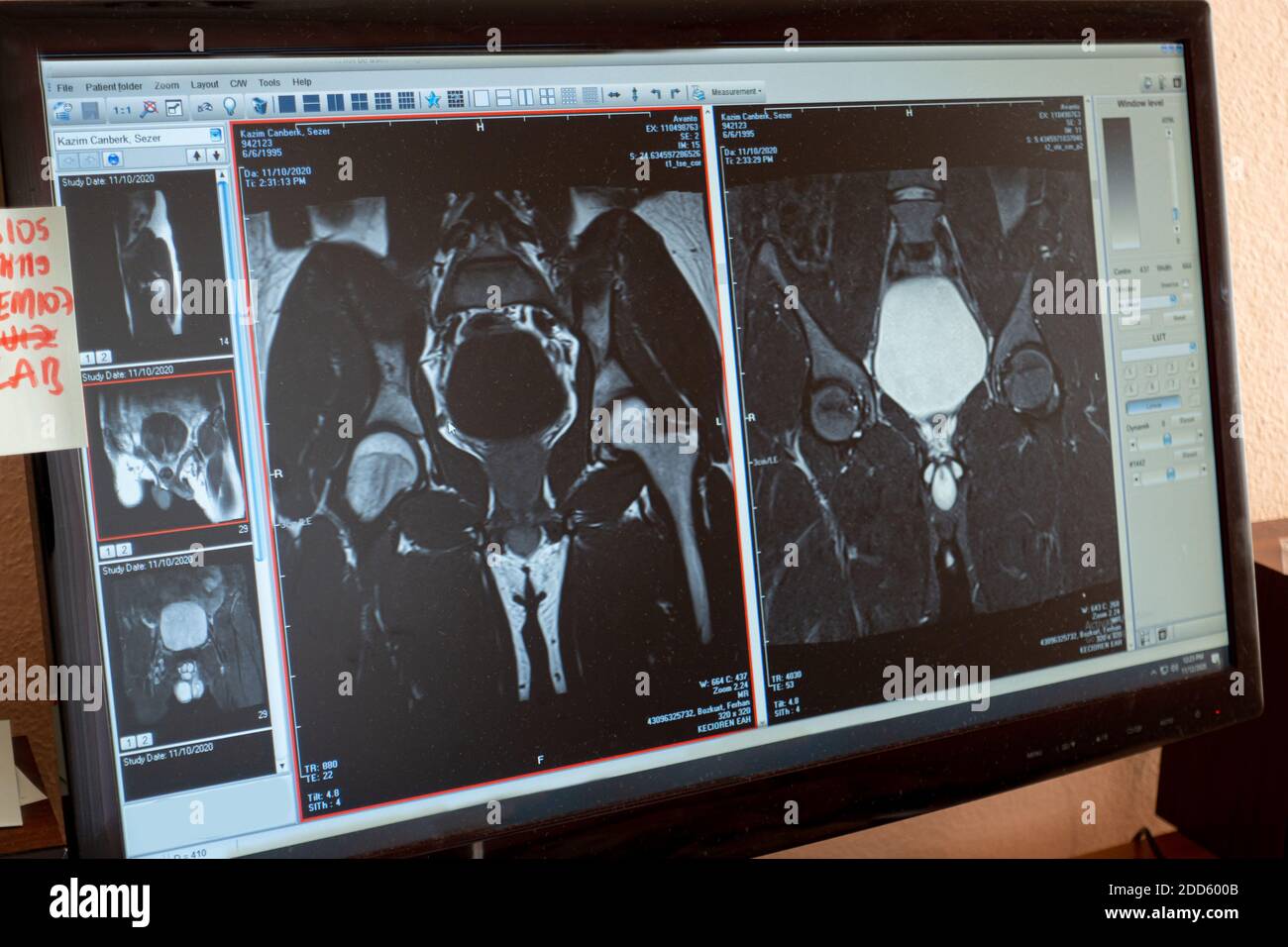 Analysis of a patient's Magnetic Resonance Imagining through the doctors private computer Stock Photo