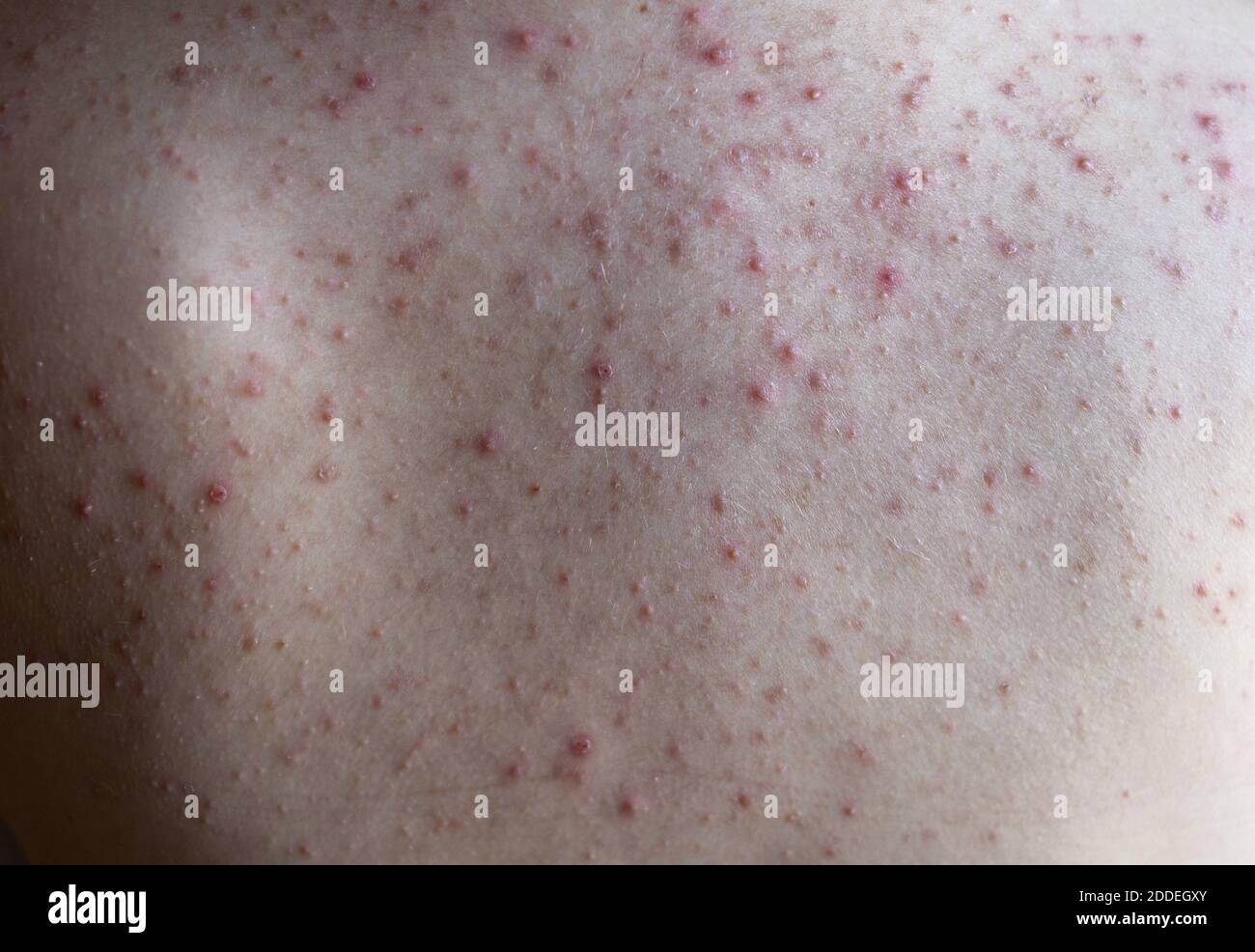 woman back with acne, red spots, skin disease Stock Photo