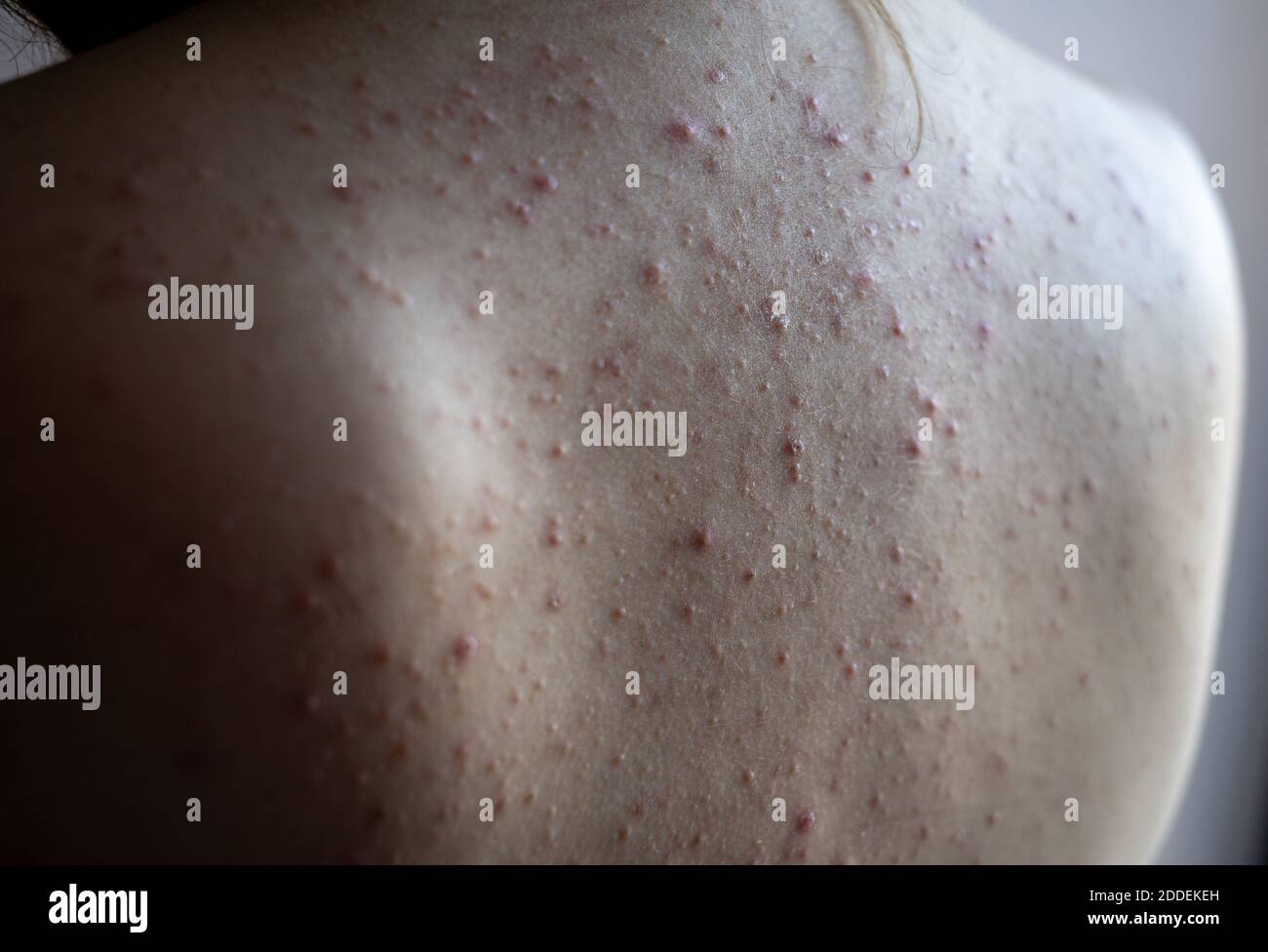 woman back with acne, red spots, skin disease Stock Photo Alamy