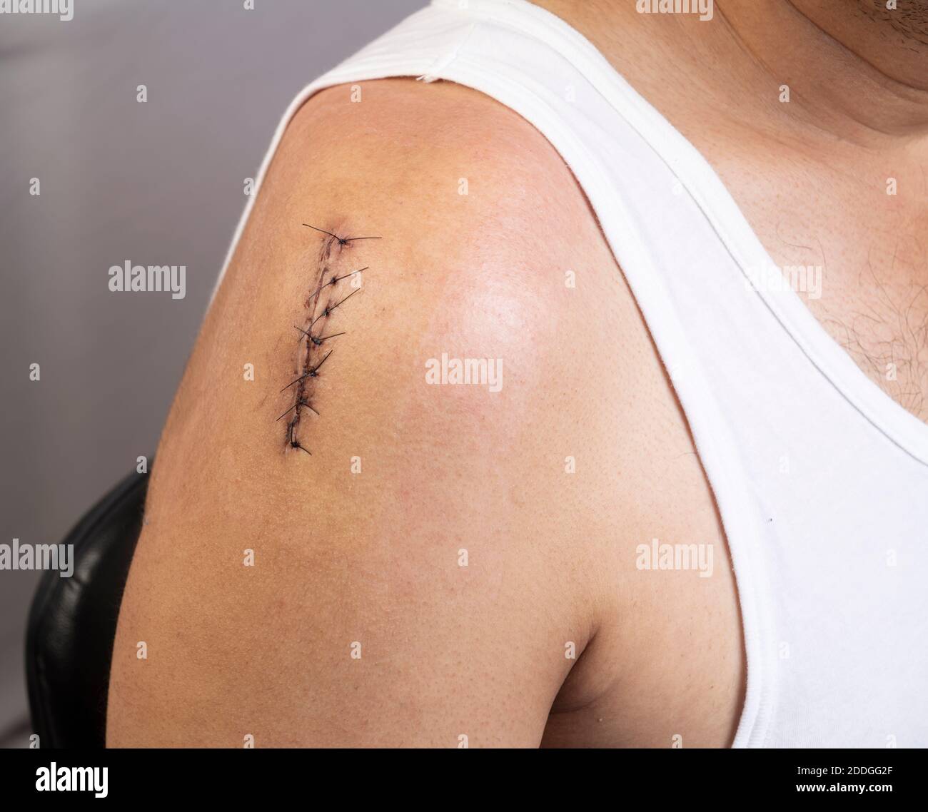 Front side closeup view of surgical incision on upper right shoulder joint closed with sutures Stock Photo