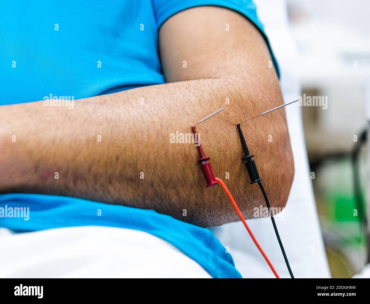 Electroacupuncture fertility treatment - Stock Image - C022/3257 - Science  Photo Library