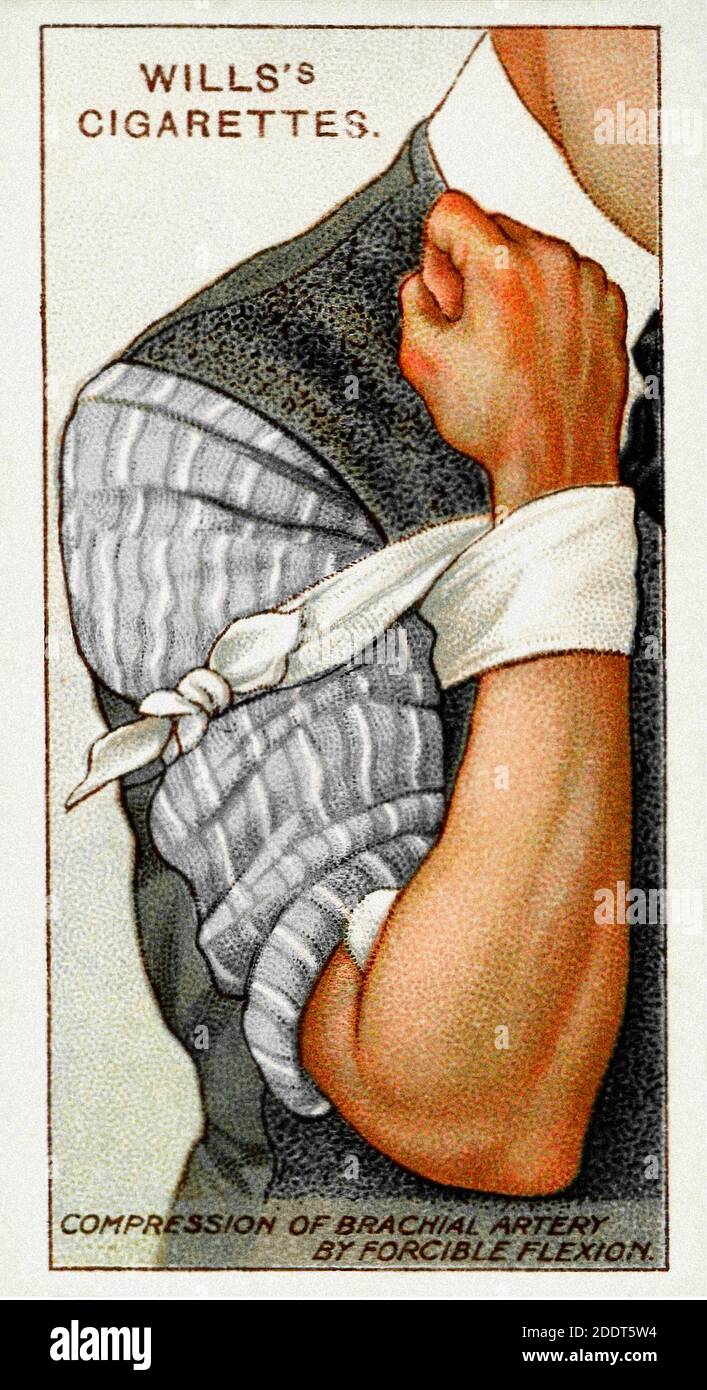 Antique cigarettes cards. Wills's Cigarettes (series First Aid ). Compression of brachial artery by forcible flexion. England. 1913 Stock Photo