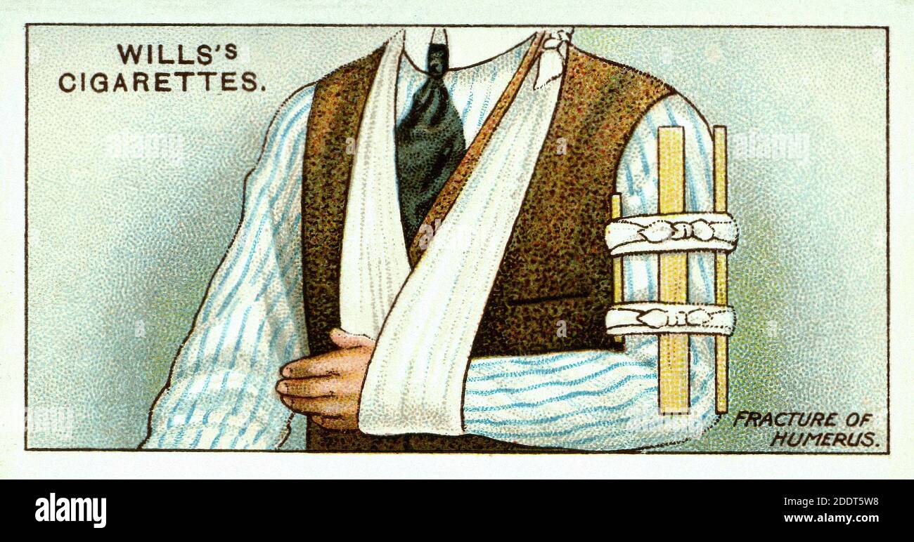 Antique cigarettes cards. Wills's Cigarettes (series First Aid ). Fracture  of Humerus. England. 1913 Stock Photo