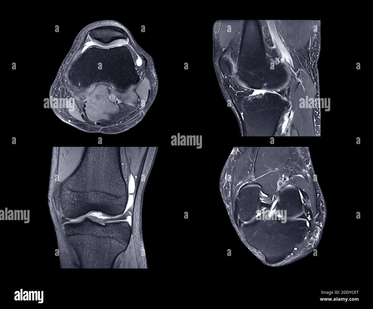 Magnetic resonance imaging or MRI knee comparison Axial, Coronal, sagittal and acl view  view for detect tear or sprain of the anterior cruciate  liga Stock Photo