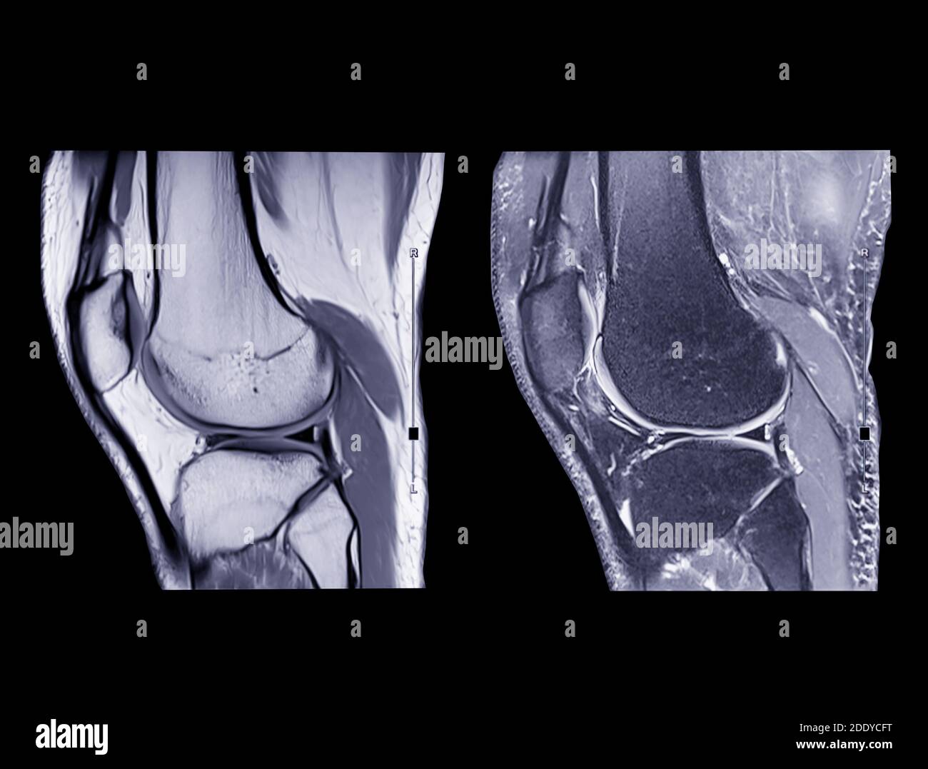 Magnetic resonance imaging or MRI knee comparison sagittal PDW and TIW view for detect tear or sprain of the anterior cruciate  ligament (ACL).clippin Stock Photo