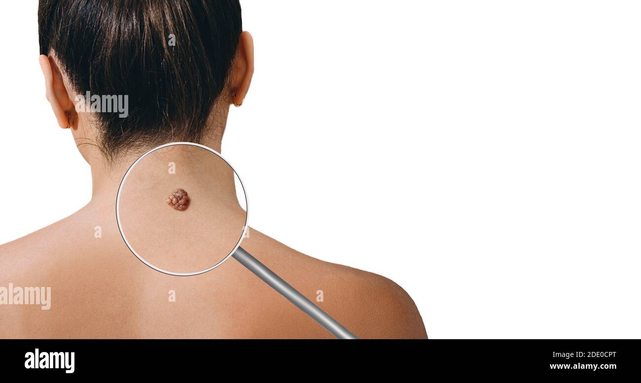 Magnifying glass showing mole on female skin. Preventive examination of a nevus on the human body Stock Photo