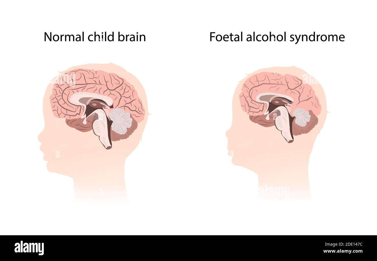 Foetal alcohol syndrome, illustration Stock Photo