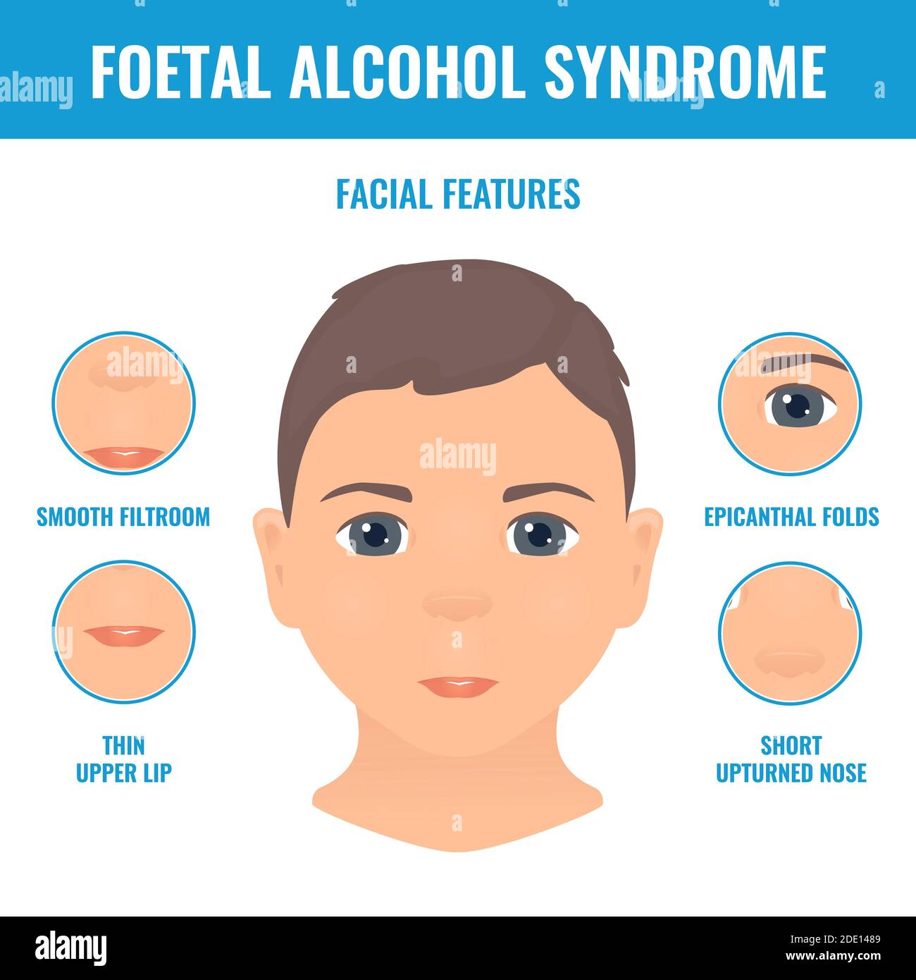 Foetal alcohol syndrome, illustration Stock Photo