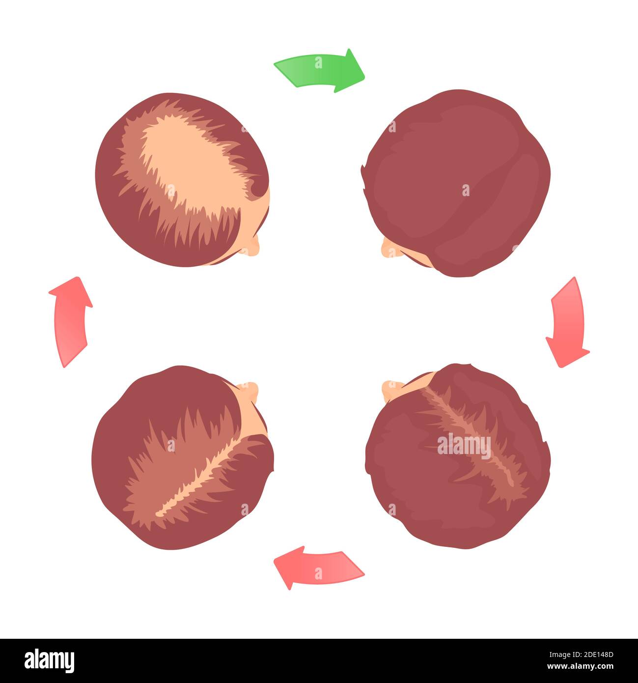 Hair loss stages in women, illustration Stock Photo