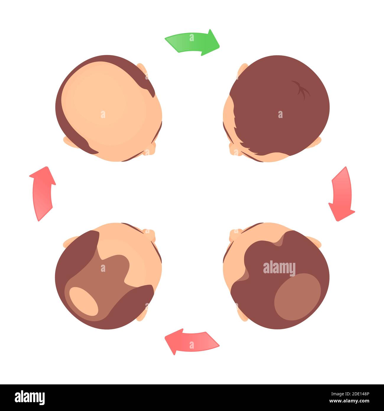Hair loss stages in men, illustration Stock Photo