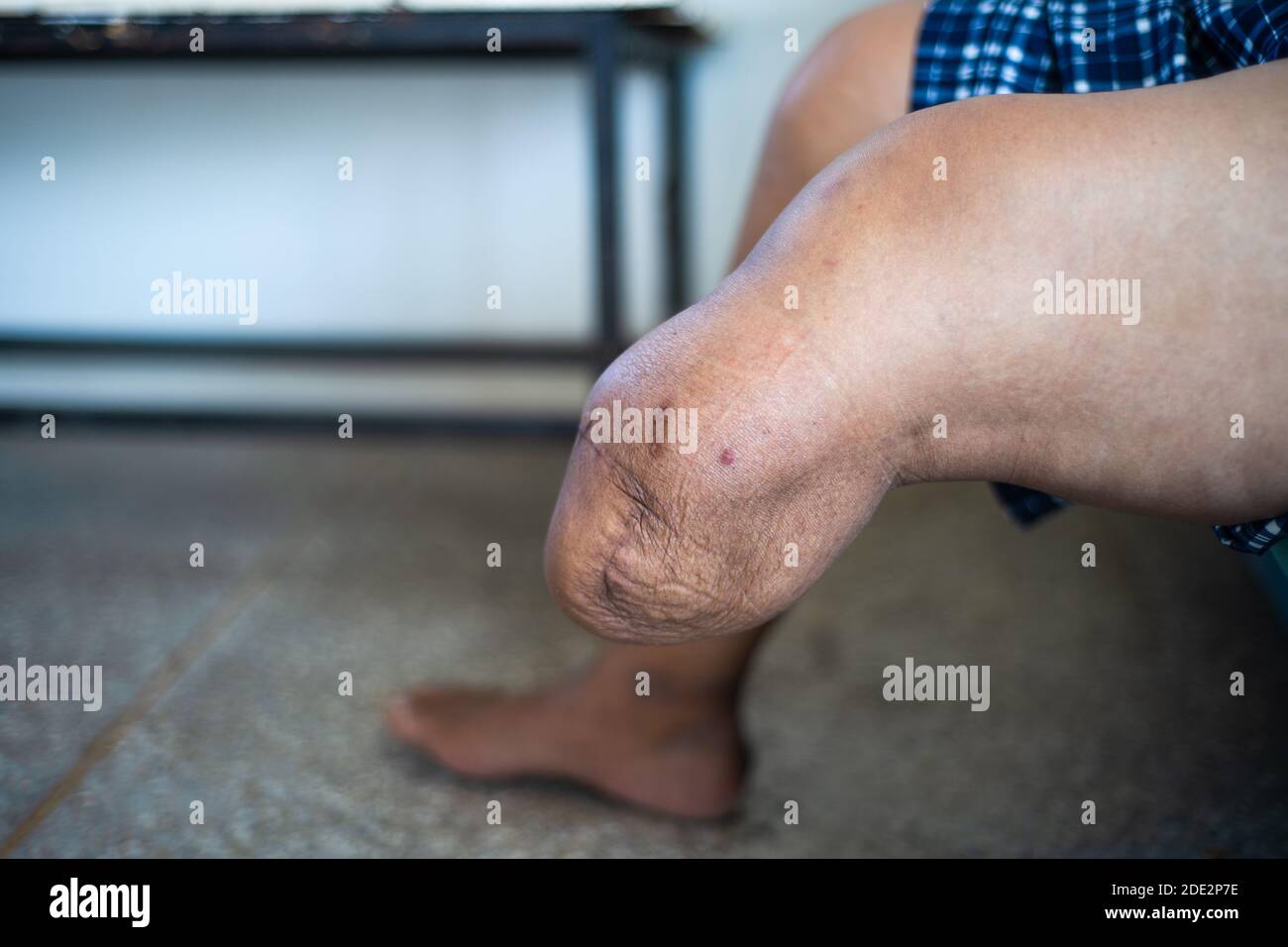 Below knee amputation stump hires stock photography and images Alamy