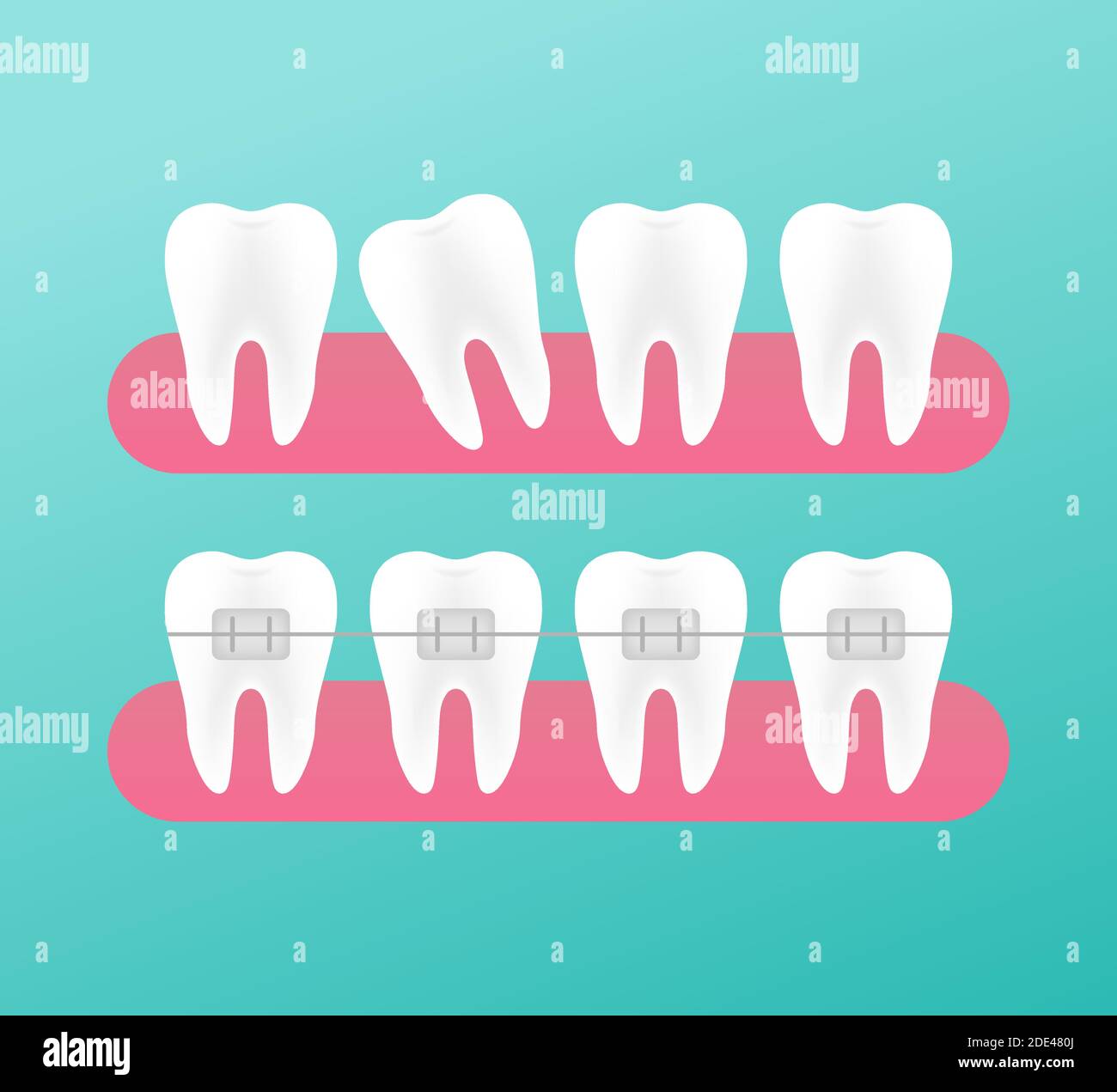 Correction Of Teeth With Orthodontic Braces. Stages Of Teeth Alignment ...