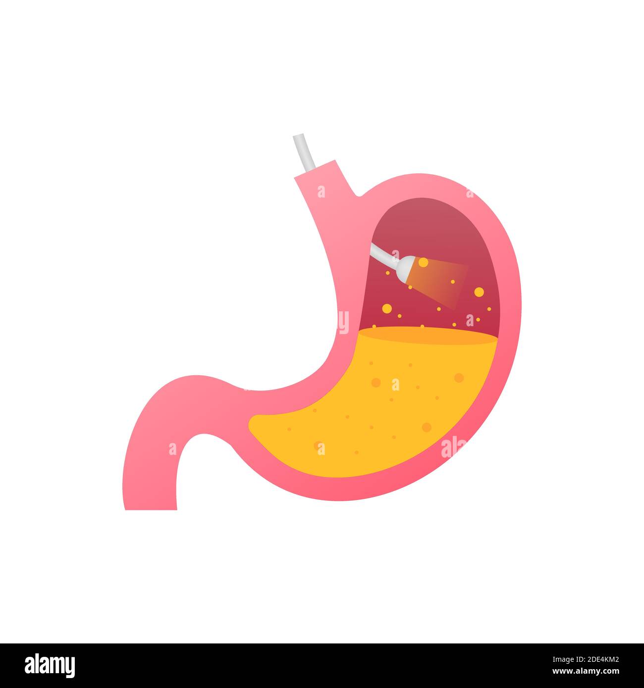 Stomach endoscopy. Endoscope in stomach through esophagus. Vector stock illustration. Stock Vector