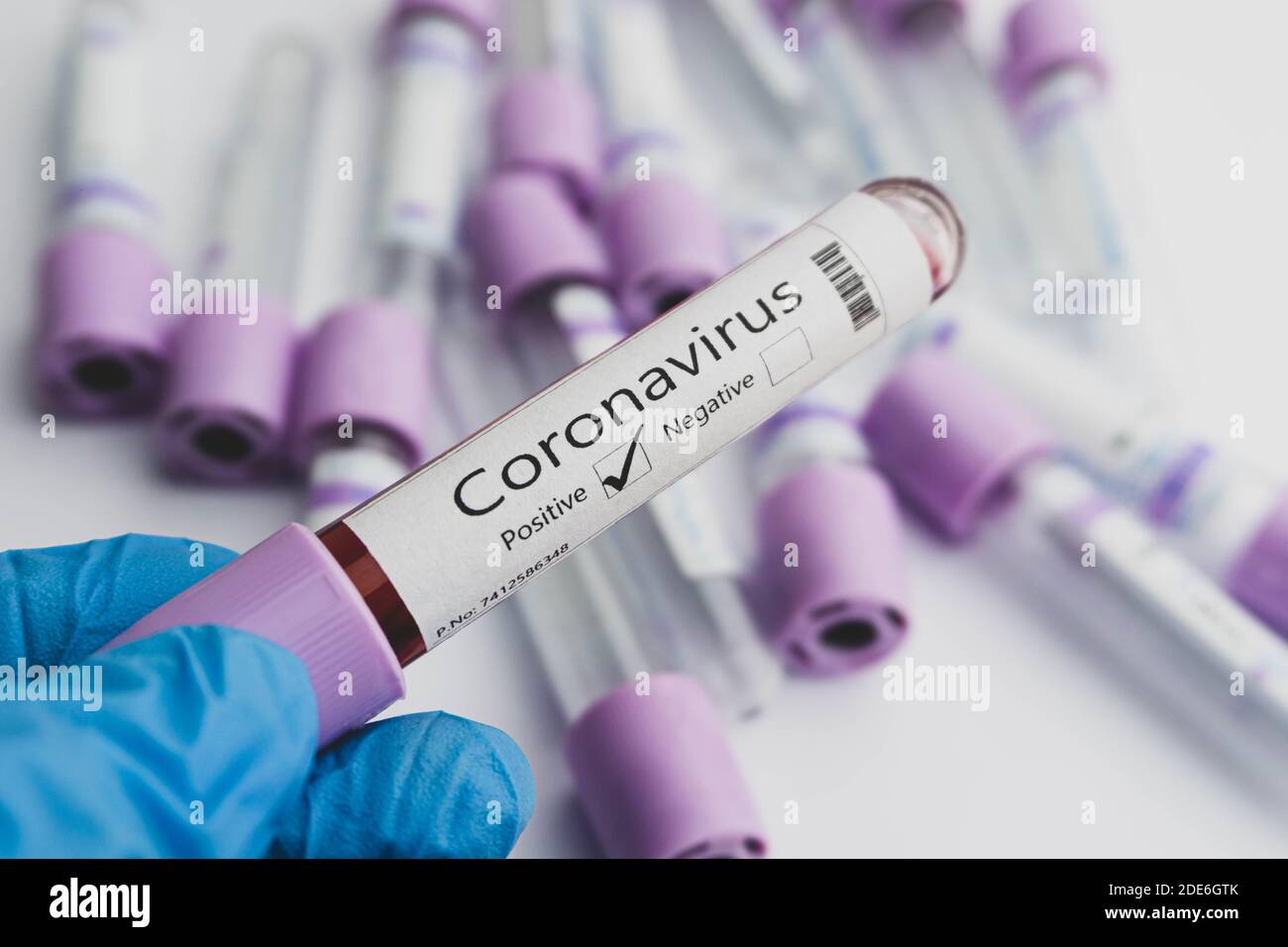 Blood test samples for presence of coronavirus (COVID-19) tube containing a blood sample that has tested positive for coronavirus. Covid-19 concept. Stock Photo