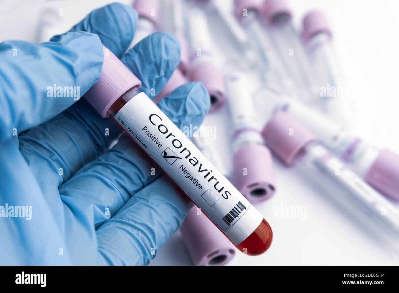 Positive COVID-19 test and laboratory sample of blood testing for diagnosis new Coronavirus outbreaking concept. Stock Photo