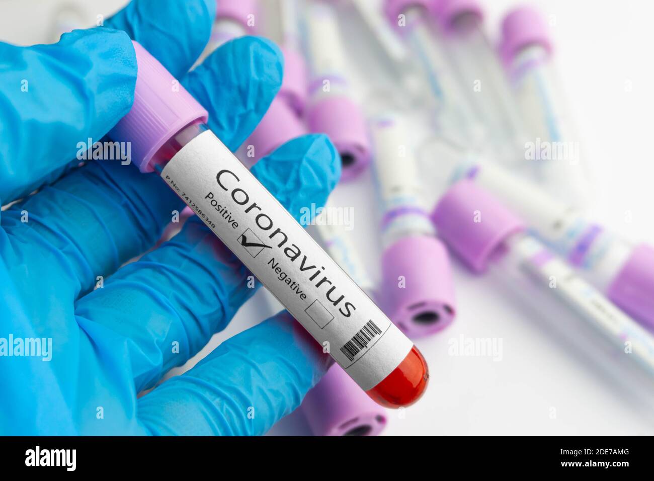 The doctor is holding a coronavirus positive blood test sample in his hand. Covid-19 concept. Coronavirus, SARS-CoV-2 outbreak. Stock Photo