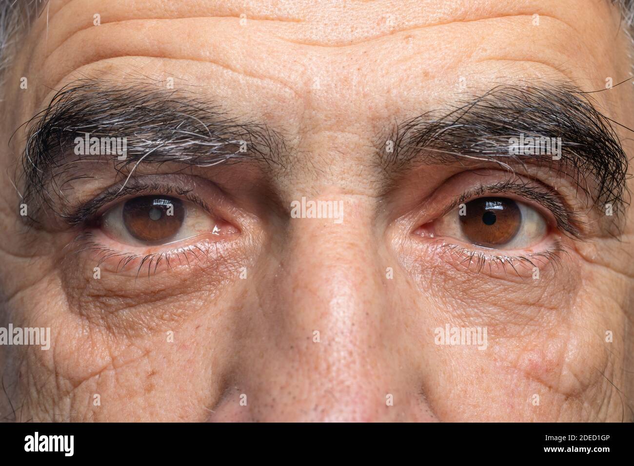 A man with cataracts is a disease of the lens of the human eye, clouding. Comparison of healthy and sick eye. Stock Photo