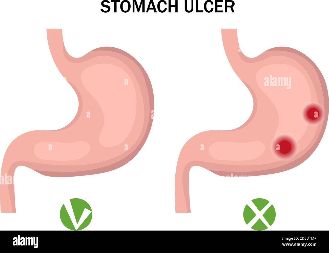 Stomach ulcer and healthy stomach infographics. Medicine concept. Vector illustration Stock Vector