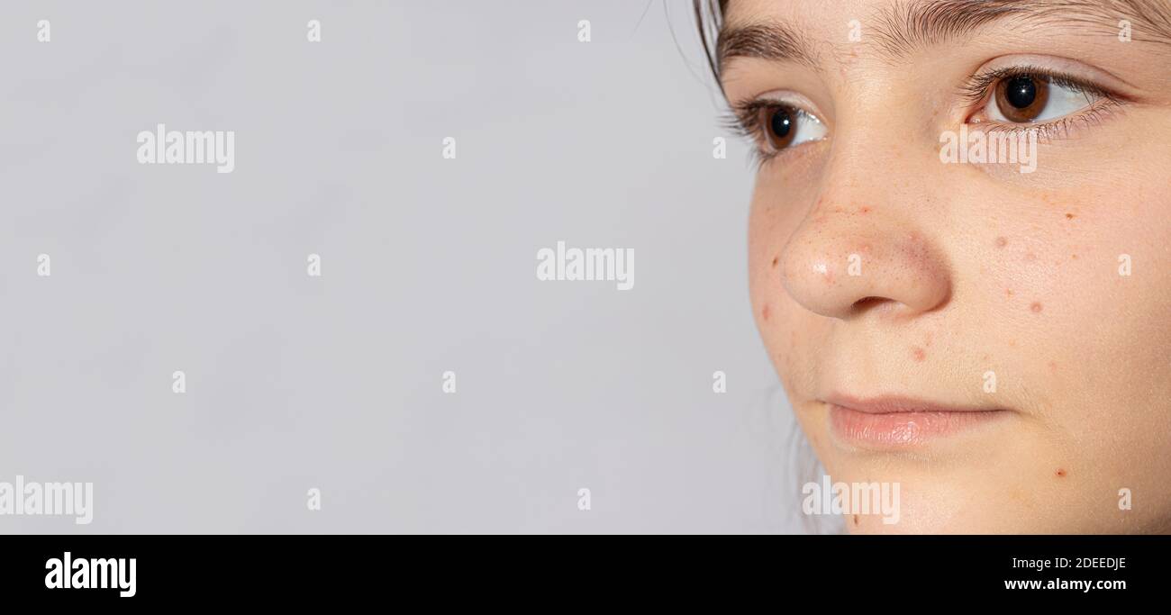 Acne in the teenage girl on the face - a banner with a place for text. Acne treatment, hormonal changes in adolescents, skin problems. Stock Photo