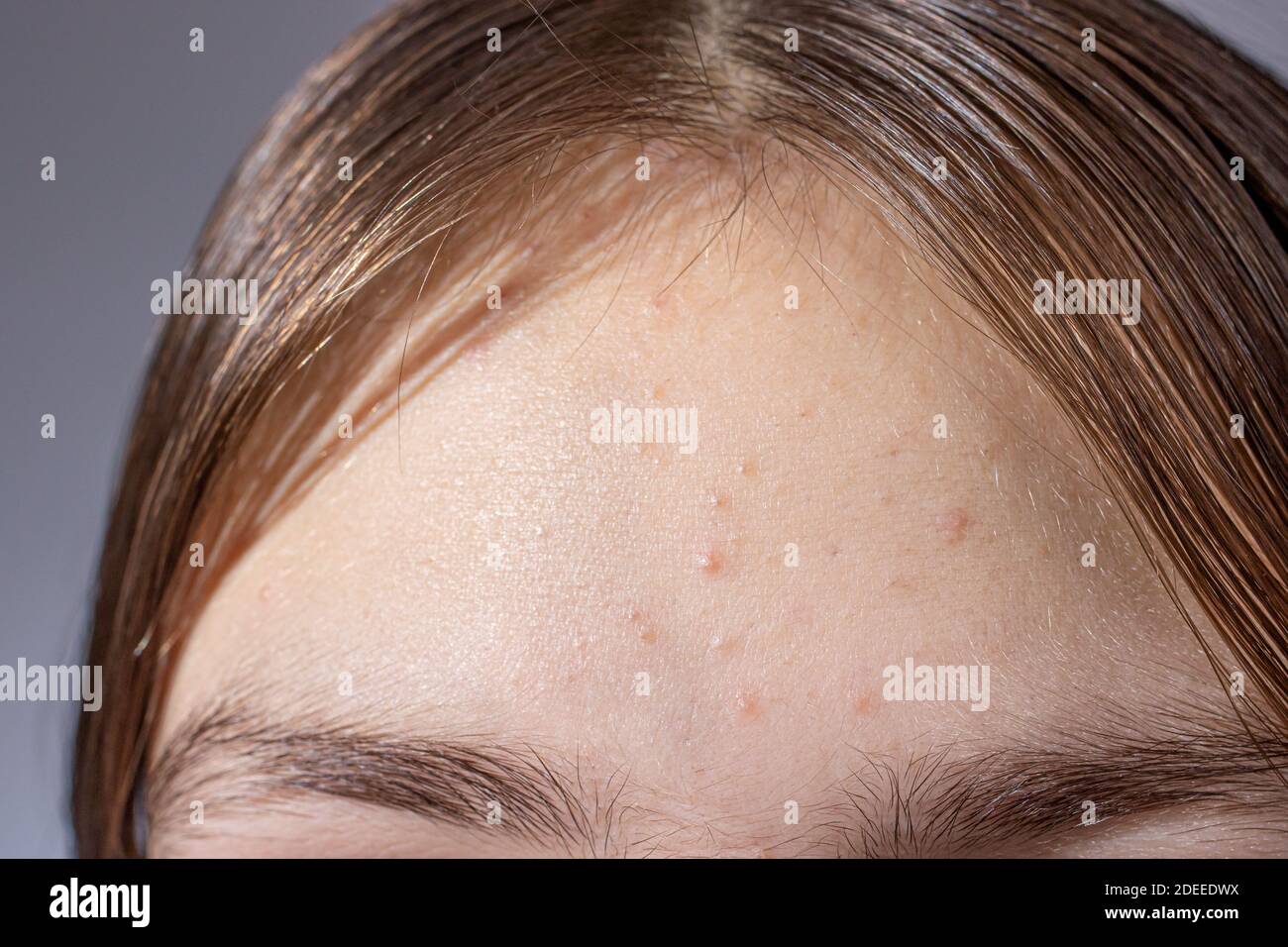 Acne on the forehead of a teenage girl - skin problems in children, acne treatment in dermatology Stock Photo