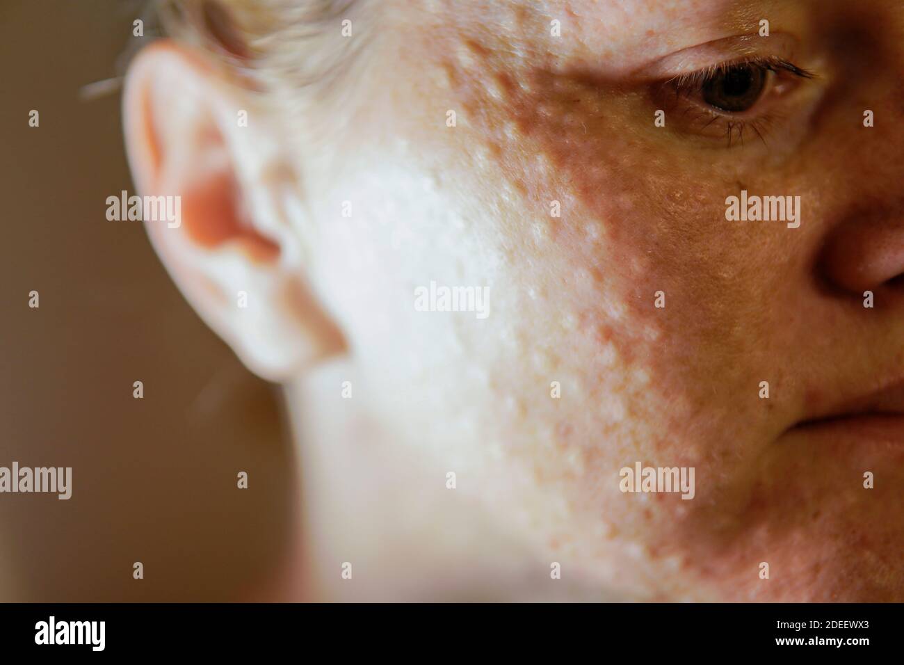 Woman's face after mesotherapy injections biorevitalization. beauty injections. high quality Stock Photo