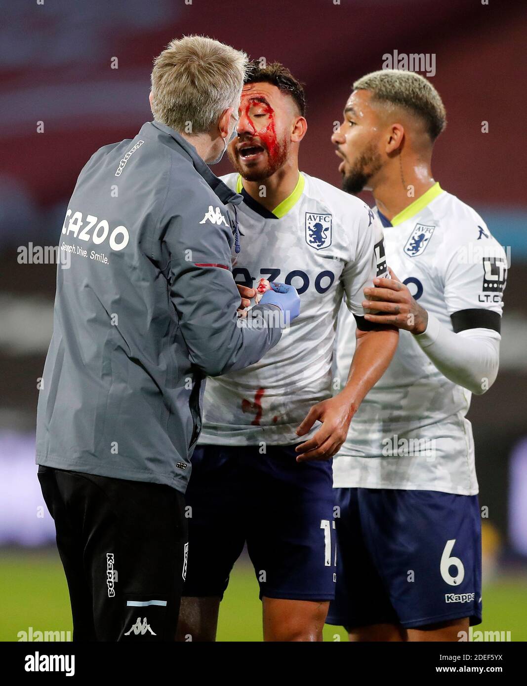 Aston Villas Trezeguet is covered in blood after a collision which results in him winning a penalty during the Premier League match at the London Stadium, London Stock Photo