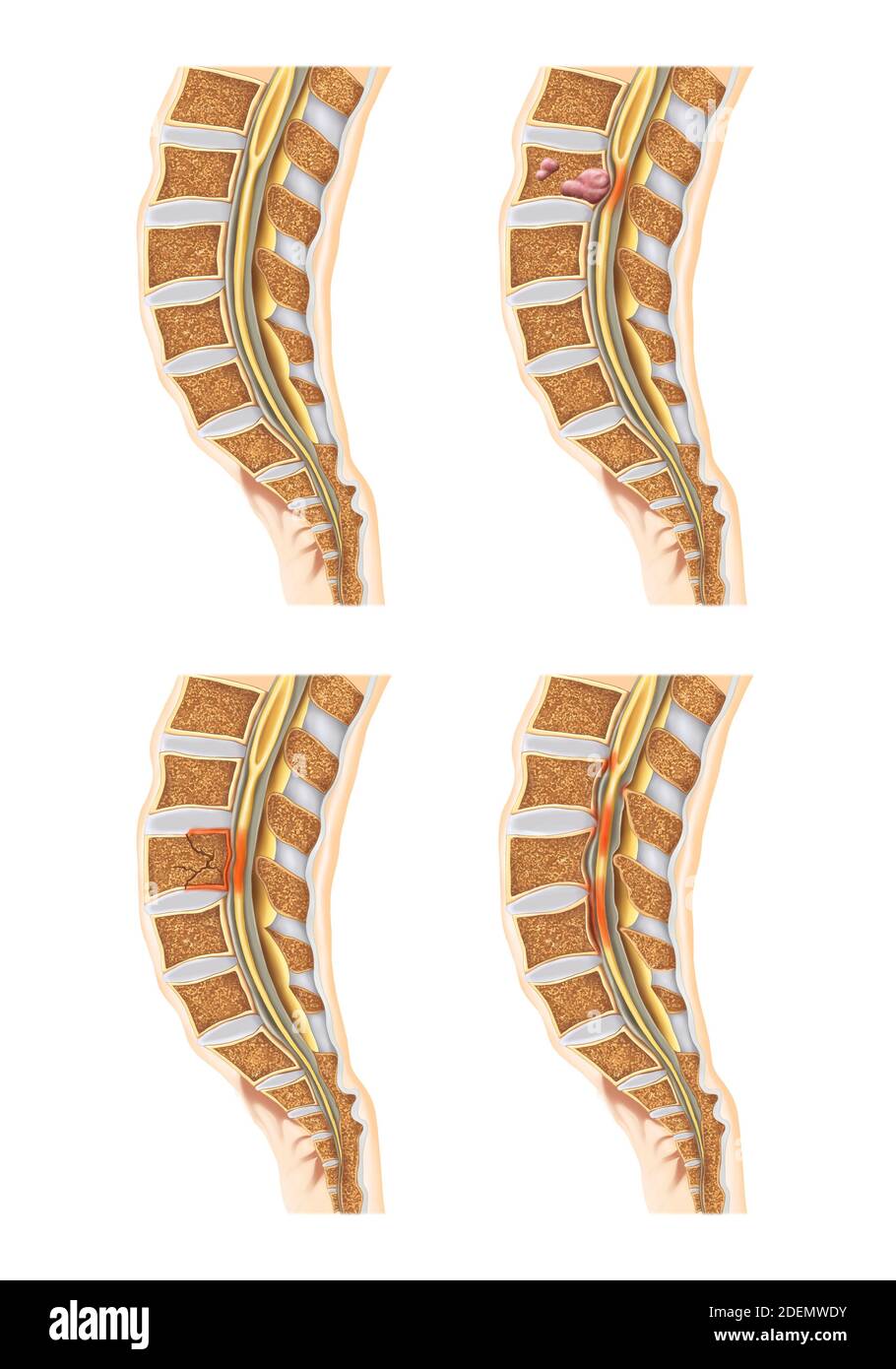 spinal and lumbar disc anatomy Stock Photo