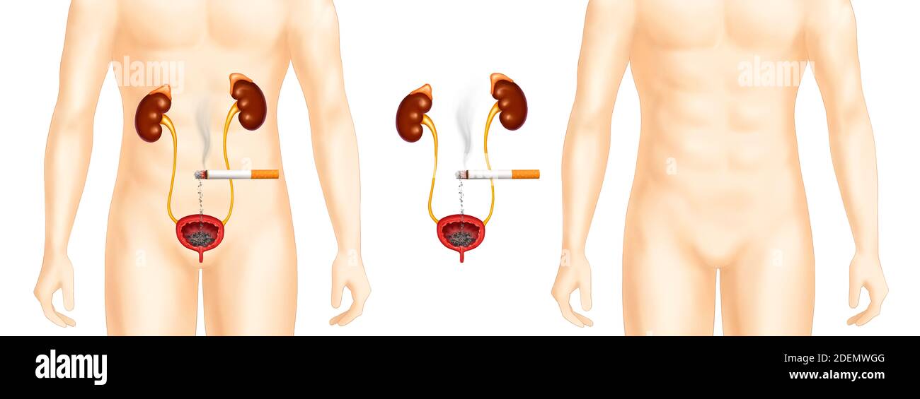 a cigarette harmful to the organs of the kidney Stock Photo