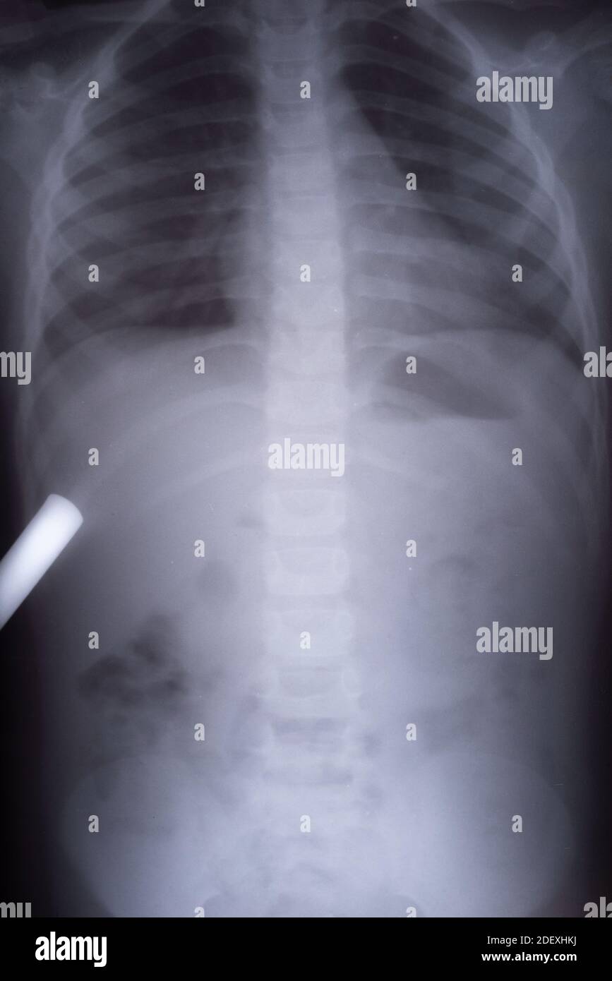 X-ray picture of gas in a child. Differential diagnosis of intestinal intussusception in a child x-ray of a humen belly with lots of gas, obstruction Stock Photo