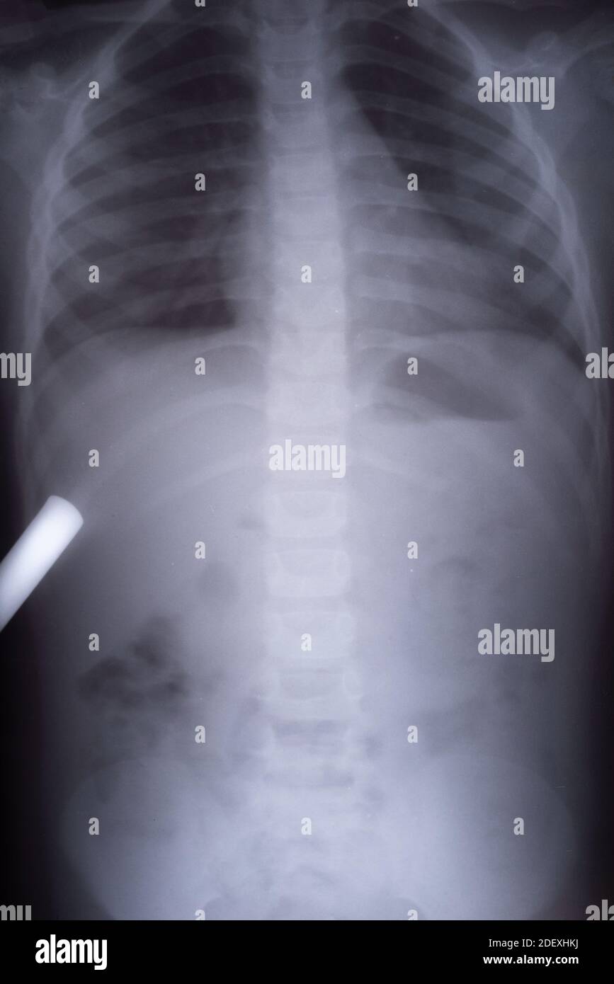 Intussusception High Resolution Stock Photography And Images Alamy