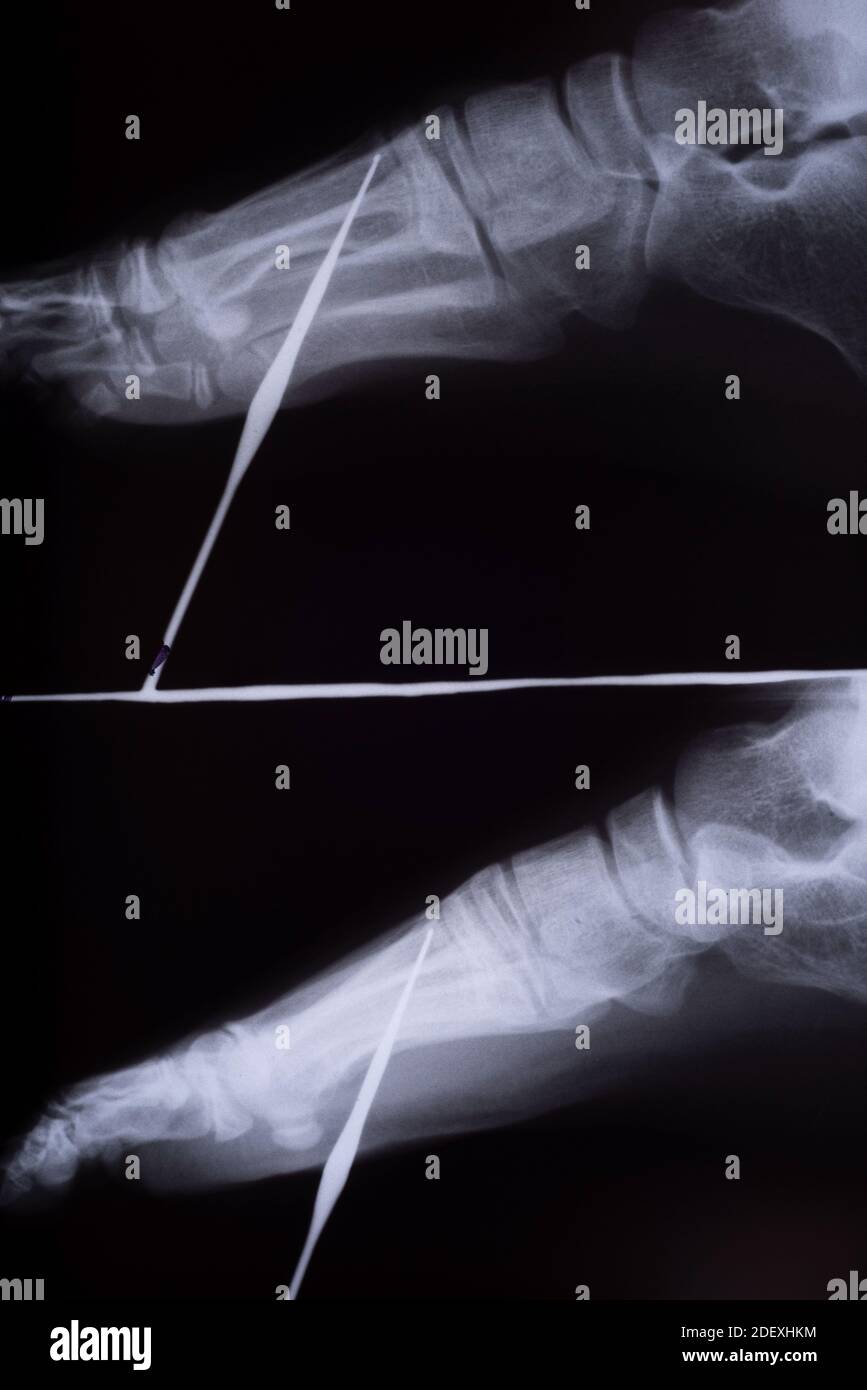 foreign body foot xray of a child Xray radiograph image of a nail