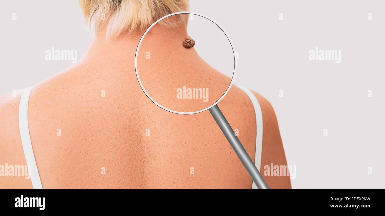Magnifying glass showing mole on elderly woman skin. Preventive examination of a nevus on the human body Stock Photo