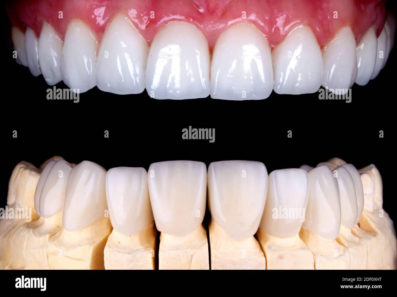 Dental crown before after hires stock photography and images Alamy