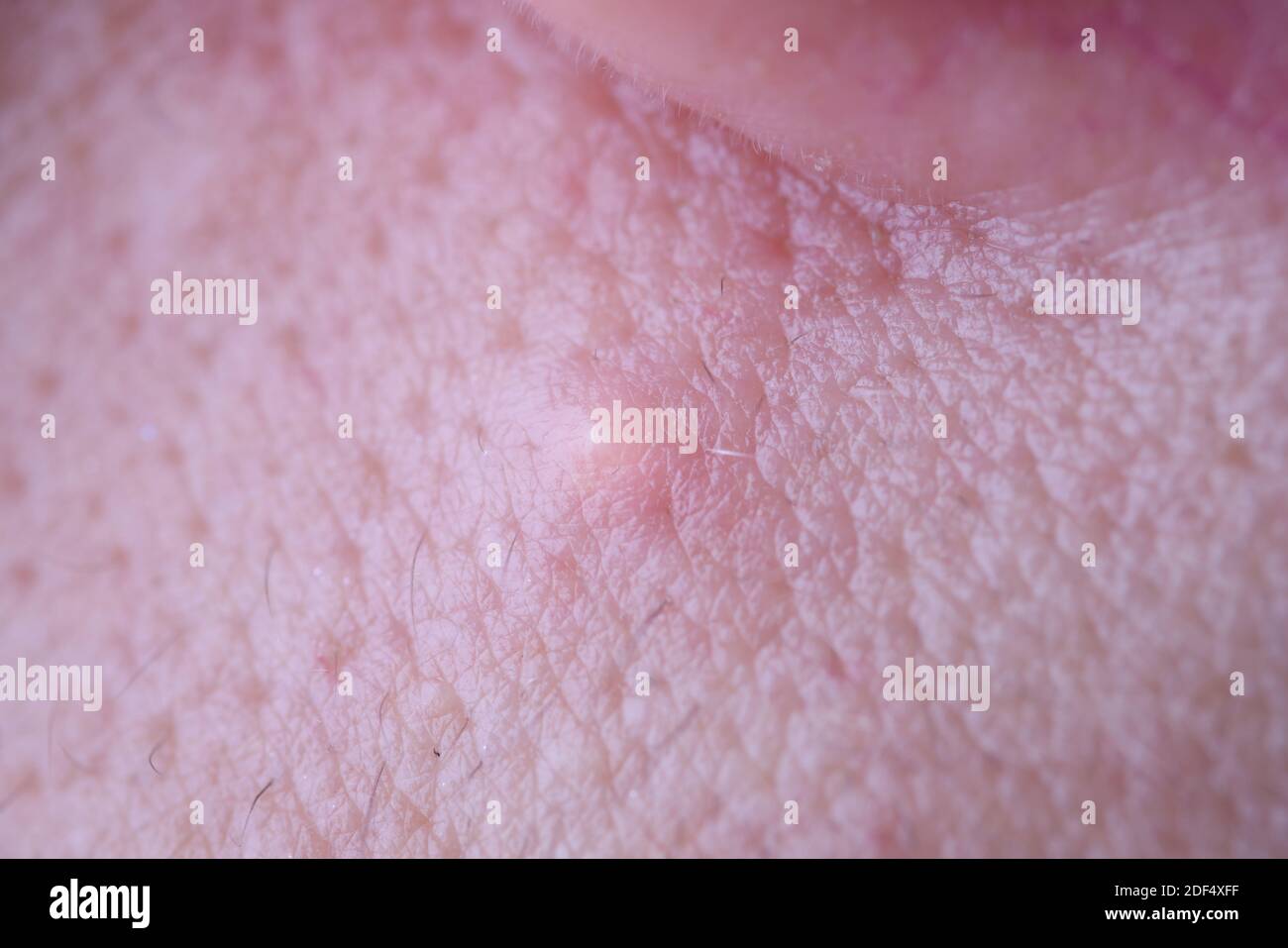 Inflammatory diseases of skin of face of teenager acne macro closeup Stock Photo