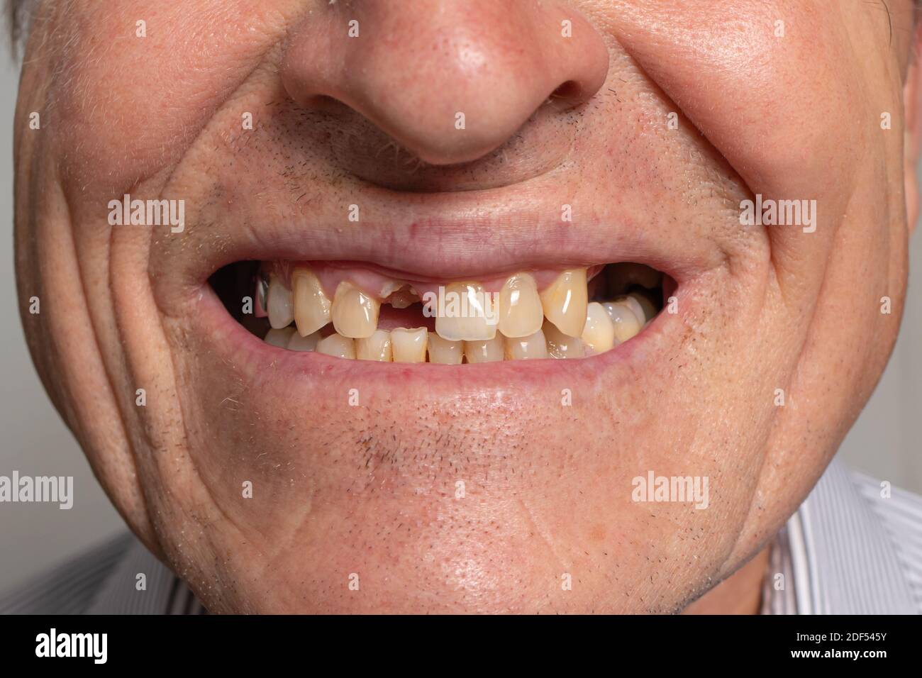 The toothless smile of an old European man on a gray background. Dentistry for pensioners, happy old age Stock Photo