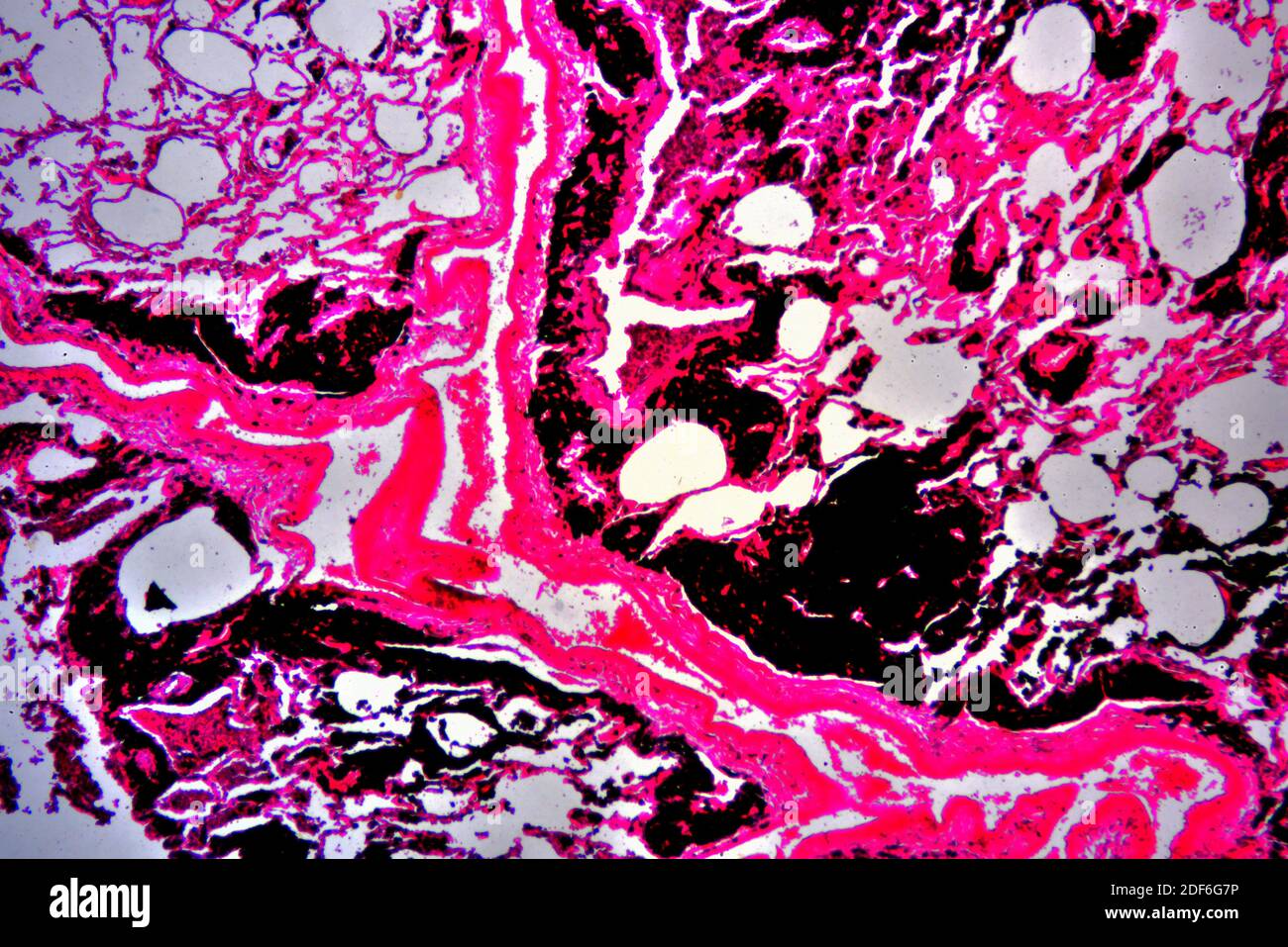 Human smoker lung with anthracosis. Optical microscope X40. Stock Photo
