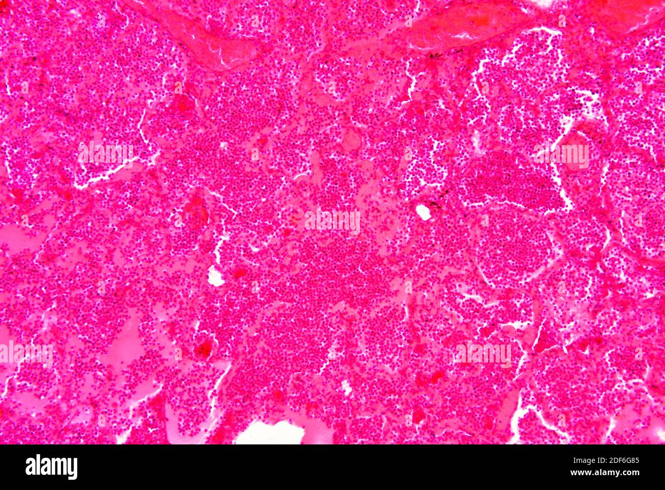 Human tuberculosis lung section. Optical microscope X100. Stock Photo