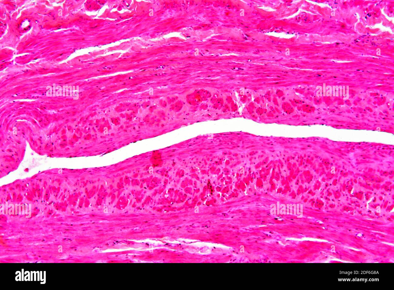 Human coronary artery with arteriosclerosis. Optical microscope X100. Stock Photo