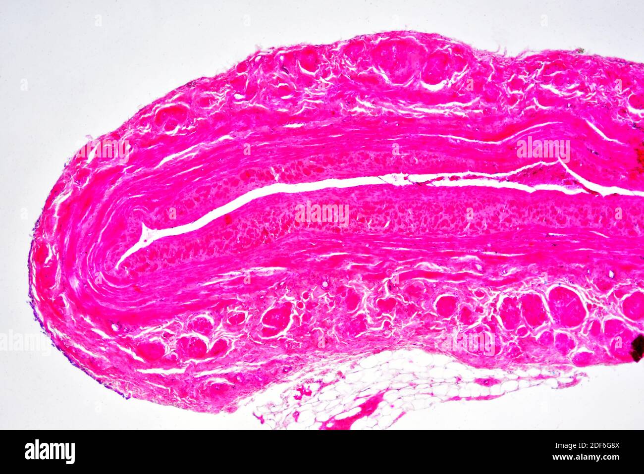 Human coronary artery with arteriosclerosis. Optical microscope X40. Stock Photo