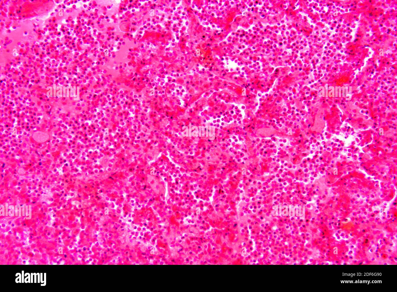 Human tuberculosis lung section. Optical microscope X200. Stock Photo