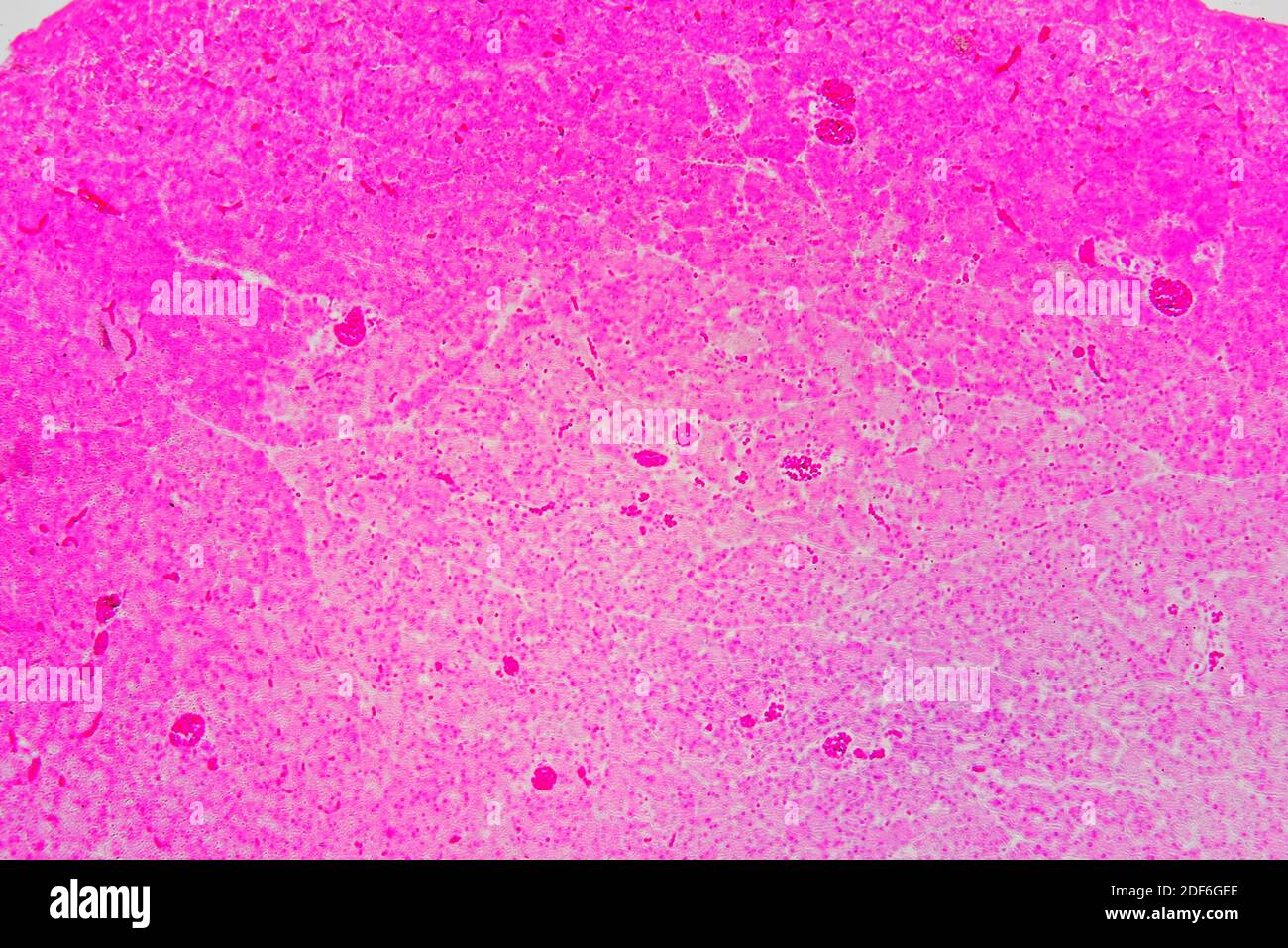 Human pancreas with diabetes Mellitus type 1 showing acin, and islets of Langerhans. Optical microscope X100. Stock Photo