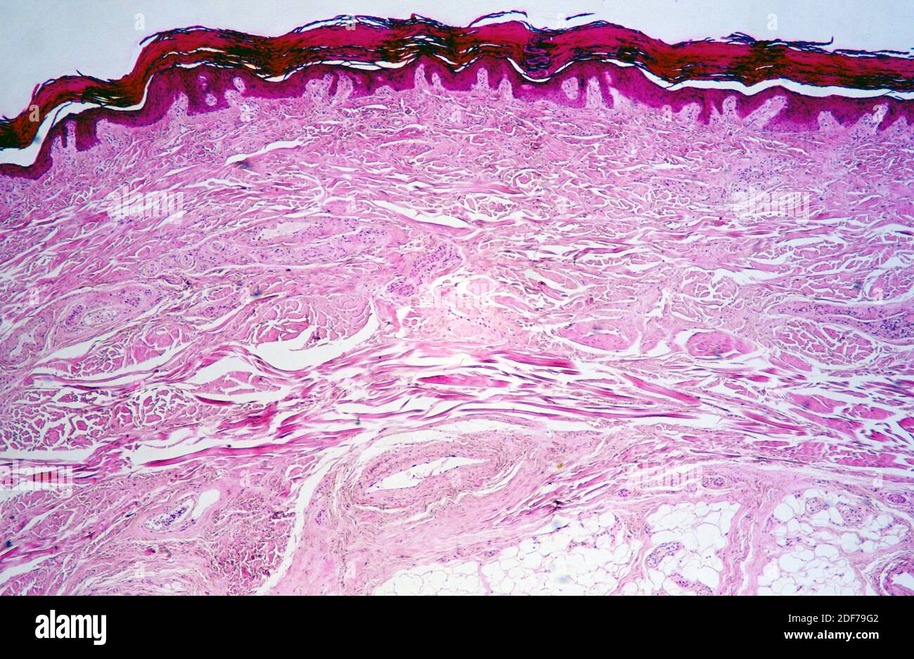 Human finger section showing epidermis (stratified squamous epithelium), dermis and connective tissues. Photomicrograph. Stock Photo