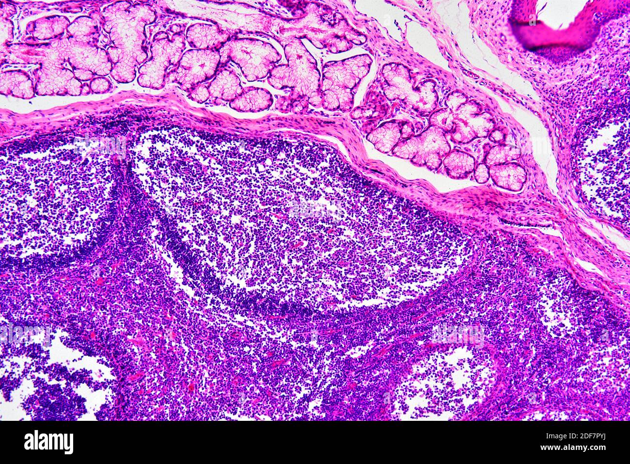Human palatine tonsil section showing circular lymphoid follicles and secretory gland. Light micrograph, haematoxylin eosin stain. X75 when printed Stock Photo