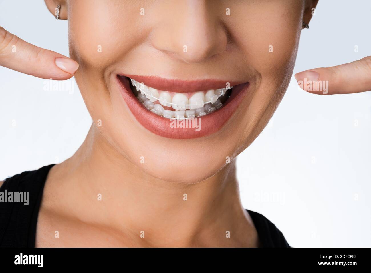 Female Mouth With Metal White Dental Braces Or Brackets Stock ...