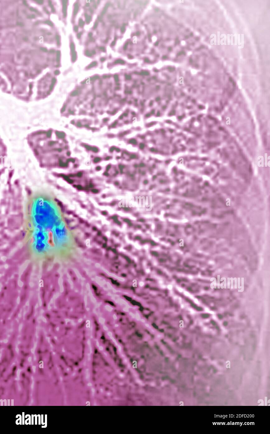 Pulmonary embolism in the left lower lobe (pulmonary artery blocked by a blood clot). Thoracic angiography. Stock Photo