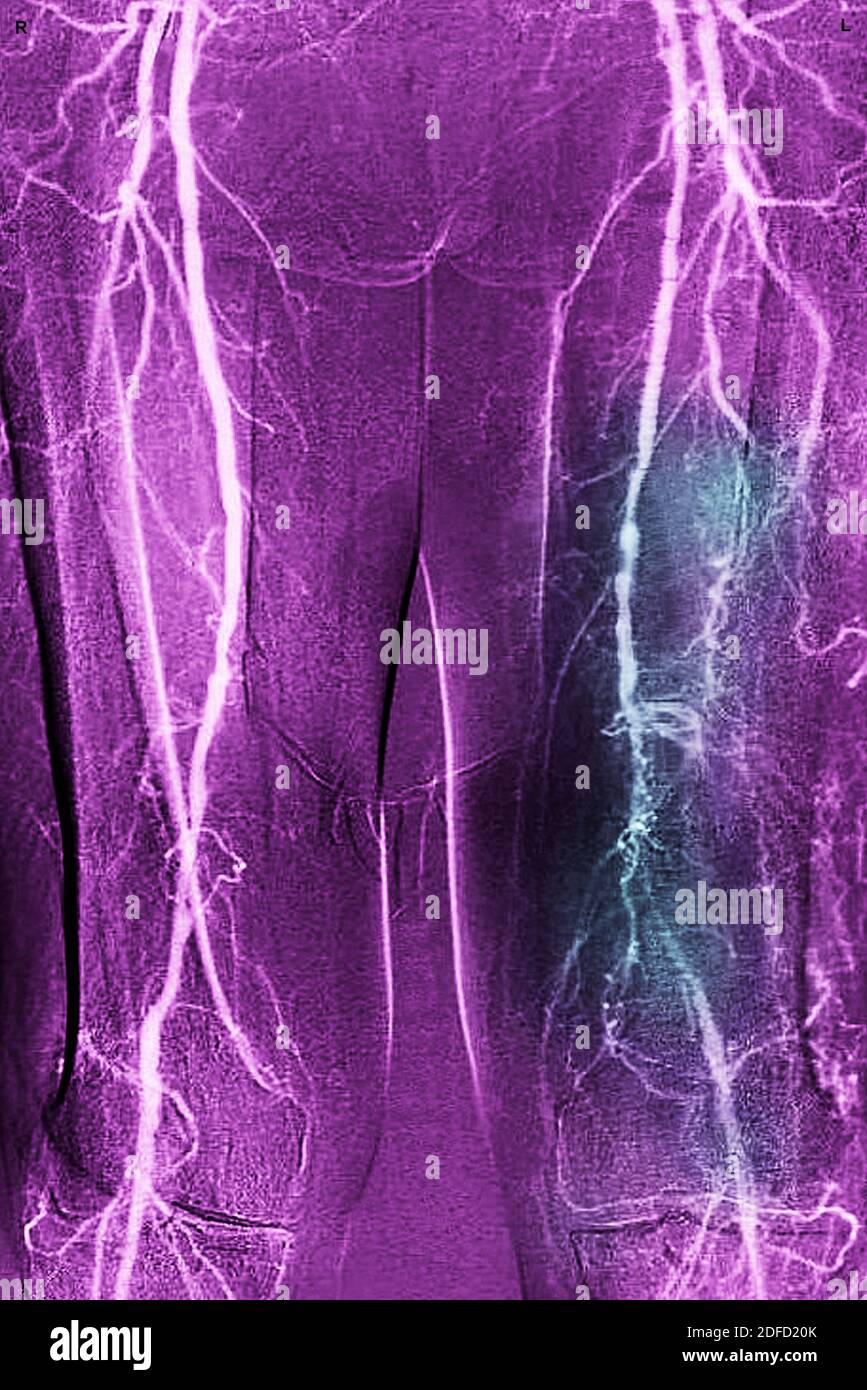Obliterating arterial disease of the lower limbs Stock Photo