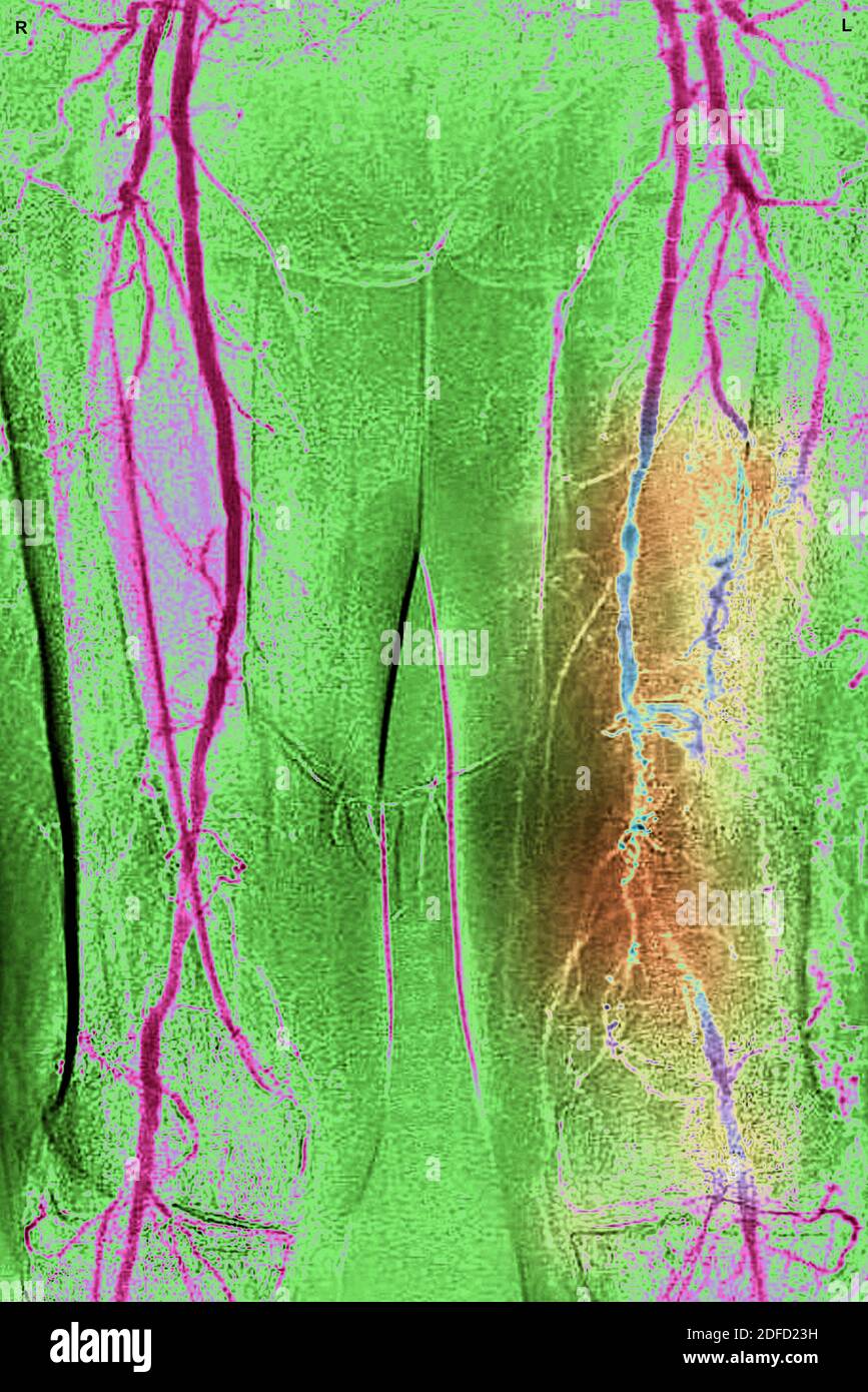 Obliterating arterial disease of the lower limbs Stock Photo