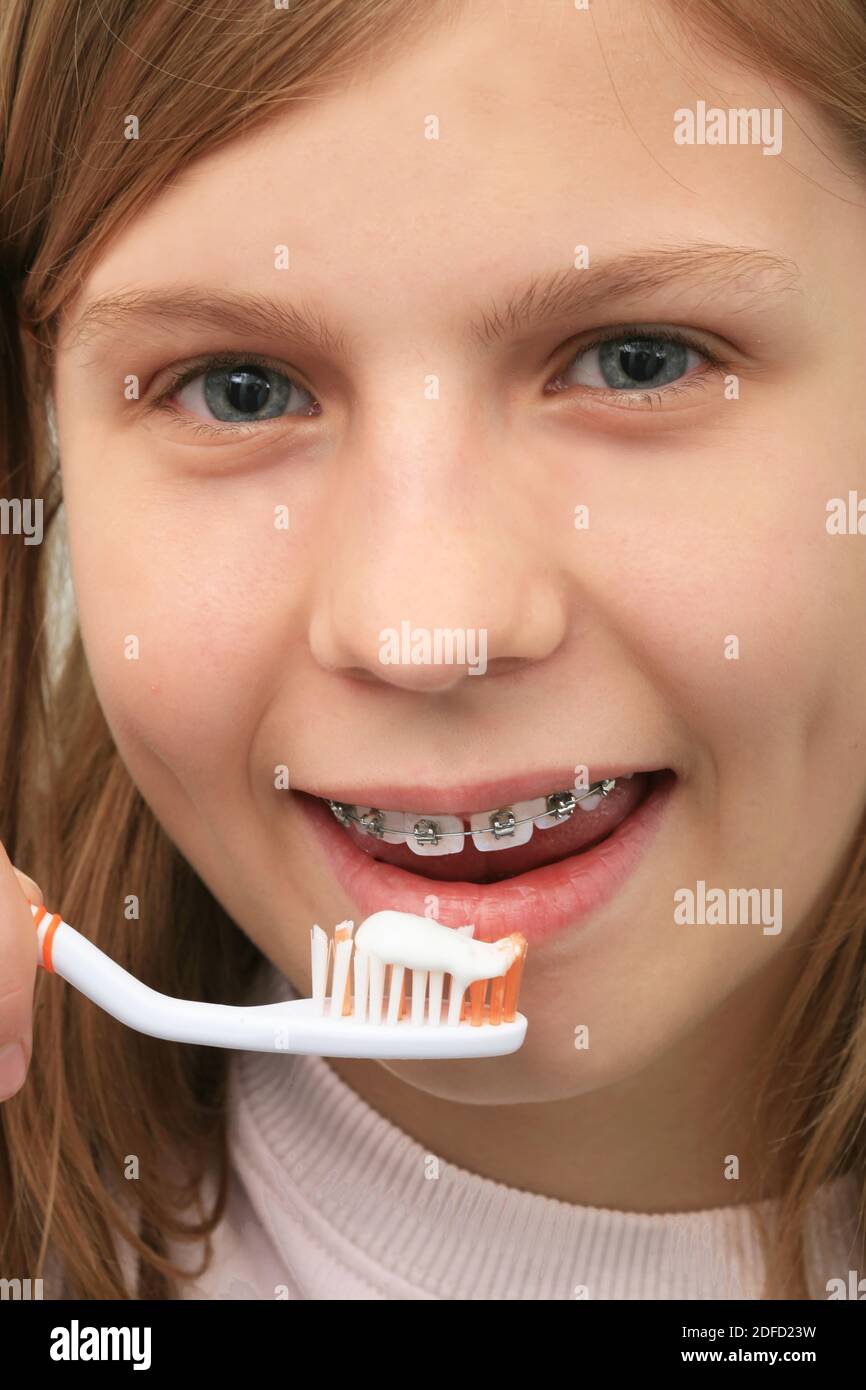 Orthodontics, braces, tooth brushing Stock Photo